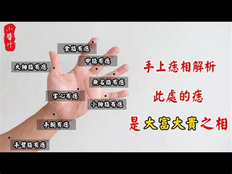 手背上有胎記|胎記怎麼產生、何時消除？醫師剖析胎記種類、胎記寓意